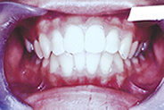 上顎前突治療前例