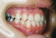 混合歯列治療前例