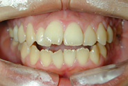 開咬治療前例