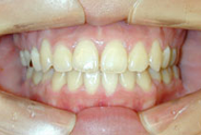 開咬治療後例