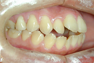 上開咬治療前例
